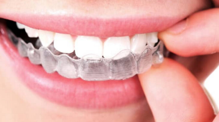 Винахід, що спрощує та здешевшує вирівнювання зубів