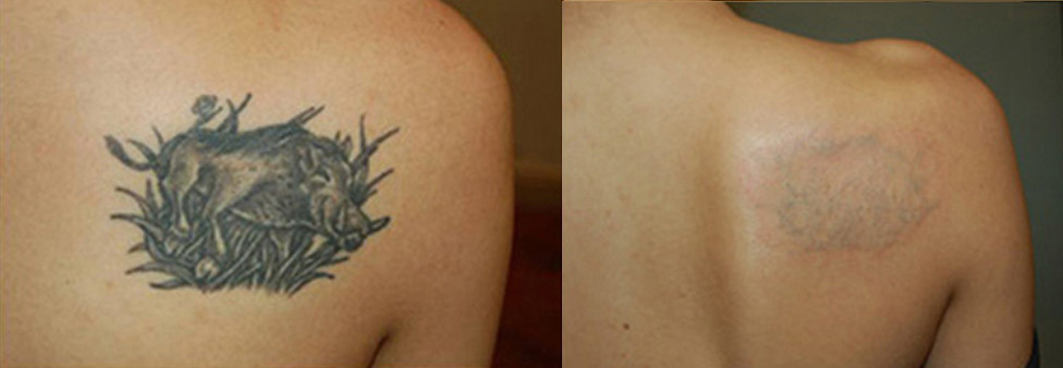 Видалення постійних тату лазером