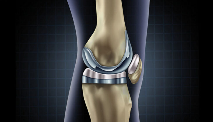 Новітні технології для створення штучних суглобів