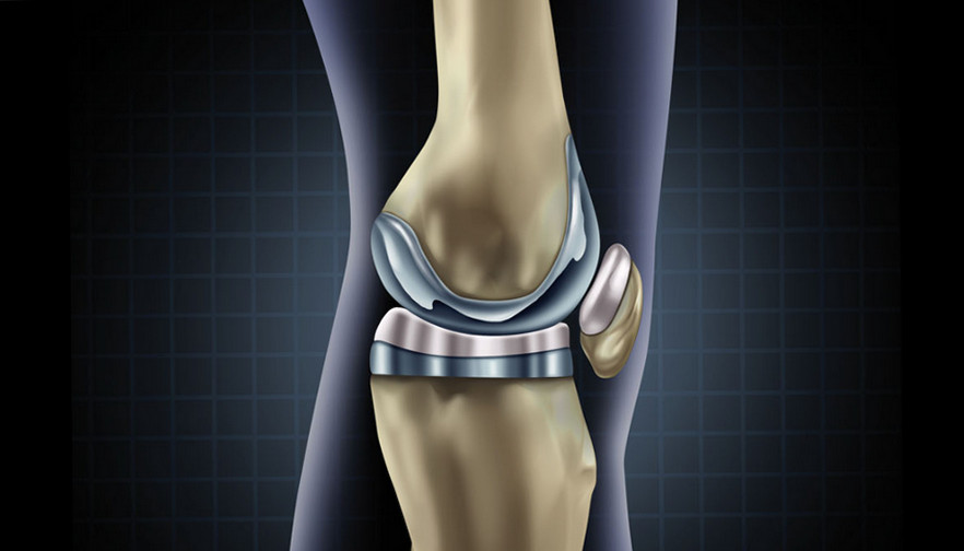 штучні суглоби